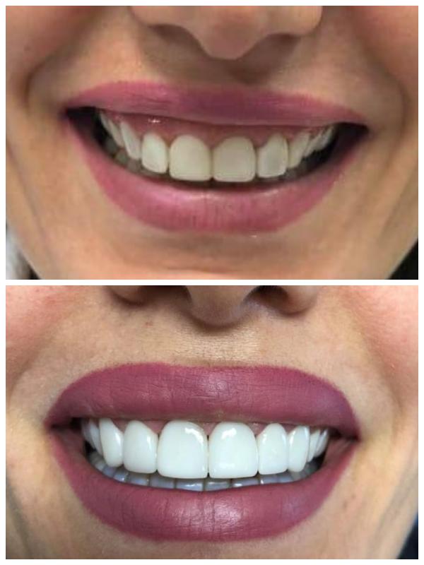 Monolithic zirconia venners 13 to 23. Old composites have been removed. Colour shade enhancement. Smile line and marginal gingiva visibility rehabilitation (gingival or gummy smile)